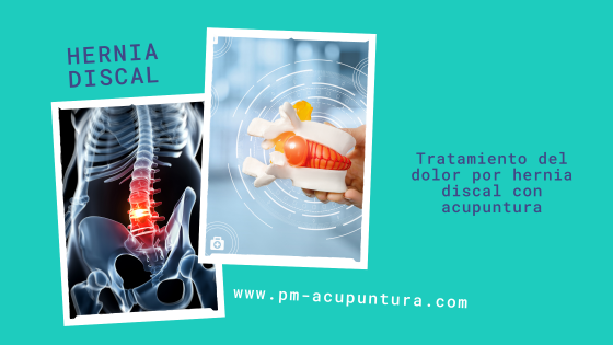 Tratamiento de la Hernia Discal Lumbar con acupuntura, traumatología